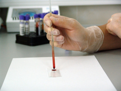 Ученые назвали вирус, который провоцирует рак крови — может привести к смерти