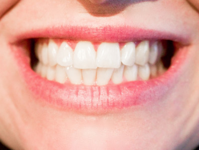 Сэкономите на стоматологе: врачи назвали 10 вредных и 10 полезных продуктов для зубов — зубная эмаль будет крепкой до 100 лет