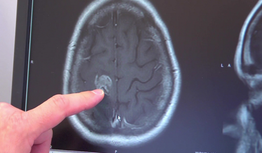 Новый препарат найден: Впервые в мире пациент вылечился от агрессивной формы рака мозга — двухлетняя выживаемость всего 10%