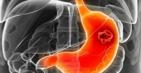 «Не чипсы и не газировка»: гастроэнтеролог Лопатина назвала истинную причину язвы и рака желудка — есть у каждого второго