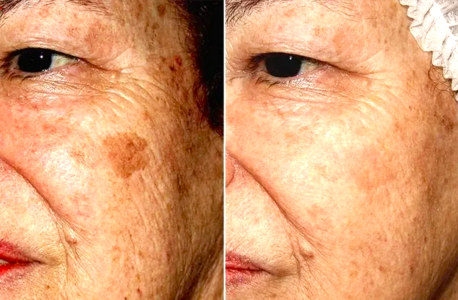 Пигментные пятна уйдут, даже если вам за 60: нанесите это средство на кожу лица всего на 5 минут и смойте водой — результат потрясающий