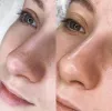 УЗ-чистка лица