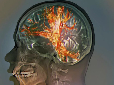 «Многие совершенно зря их игнорируют»: онколог Черемушкин назвал яркие симптомы рака мозга — если заметили это, надо срочно бежать к врачу