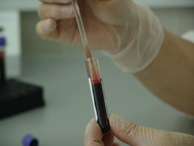 Моментальное разжижение густой крови: доктор назвал продукт от тромбоза — лекарства не понадобятся
