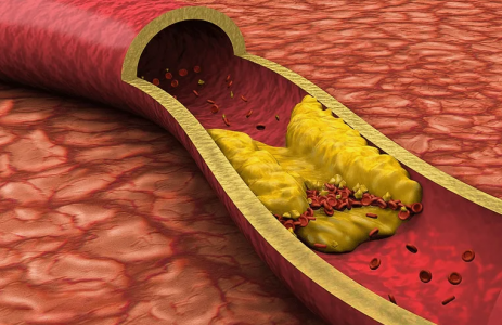 «Холестерин ни при чём»: Пьёте статины, сидите на диете, а сосуды забились ещё больше — потому что от бляшек надо избавляться по-другому